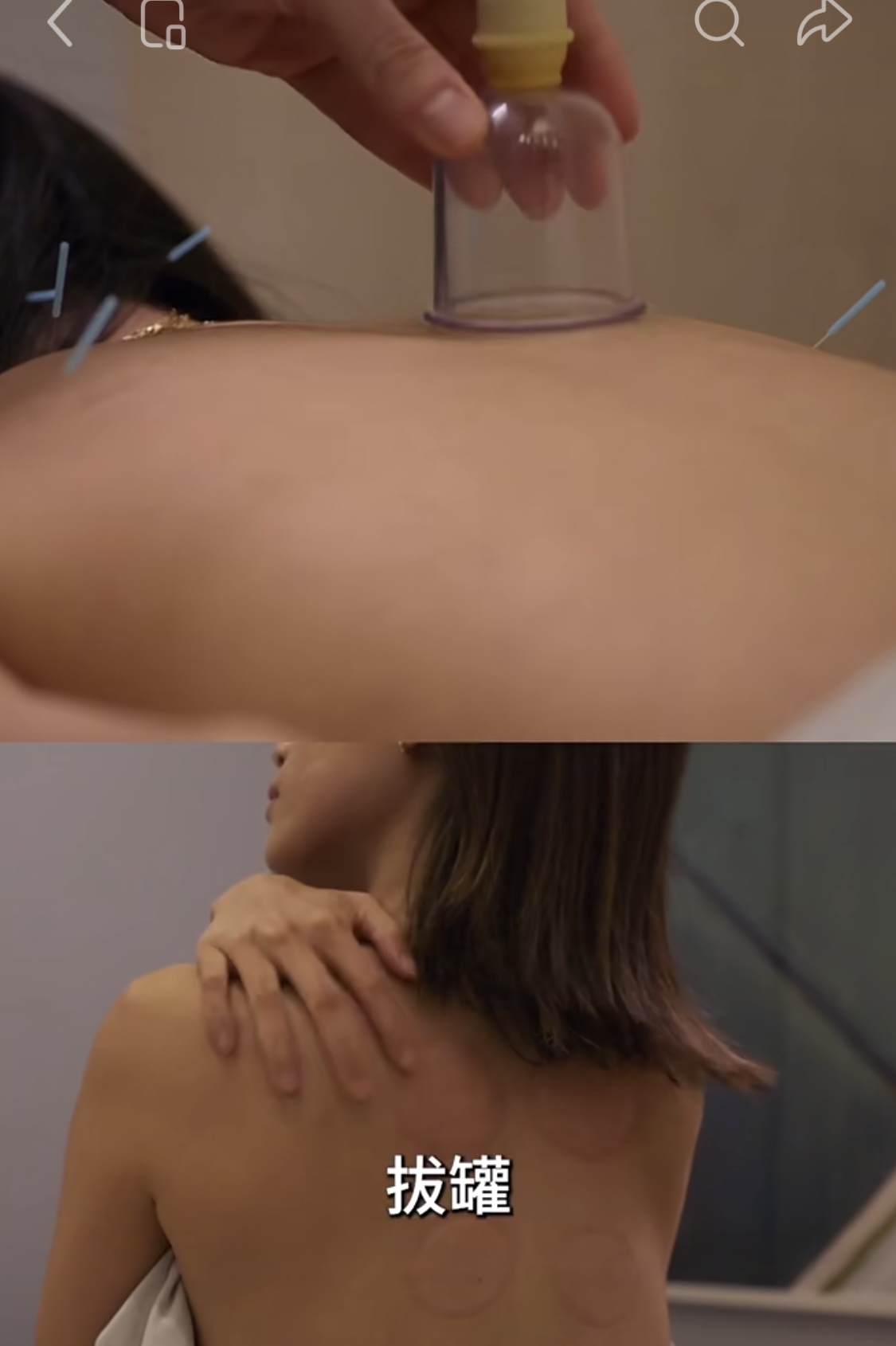 拔罐疗法 — 传统中医与现代审美结合